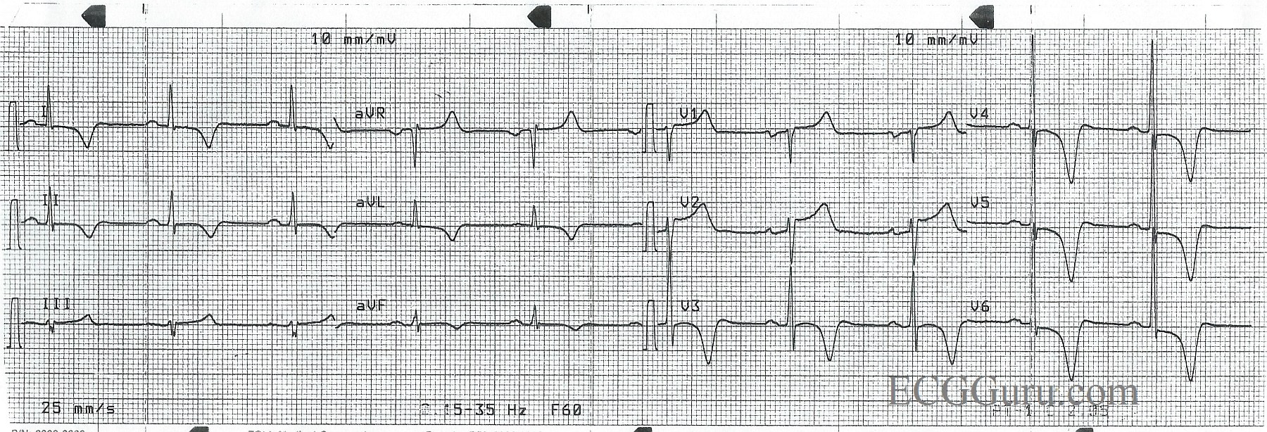 T Wave Inversion In Anterior Leads